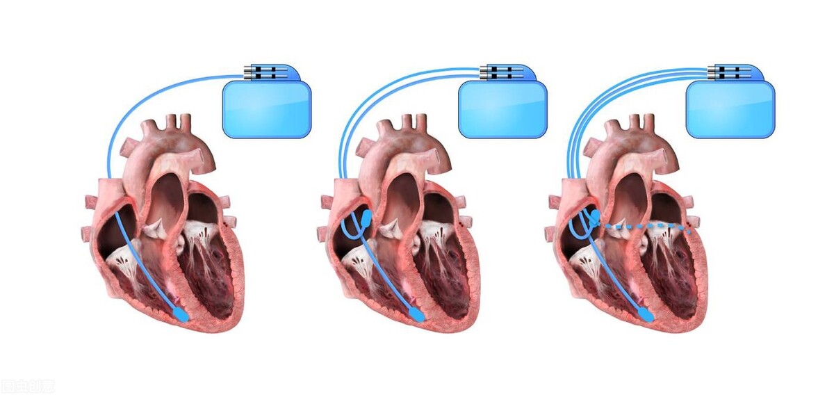 心衰的3级预防,心衰患者的预防与治疗