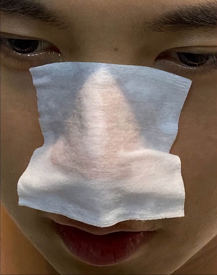 鼻子上有黑点怎么抠掉,鼻子边缘的小白点怎么去除