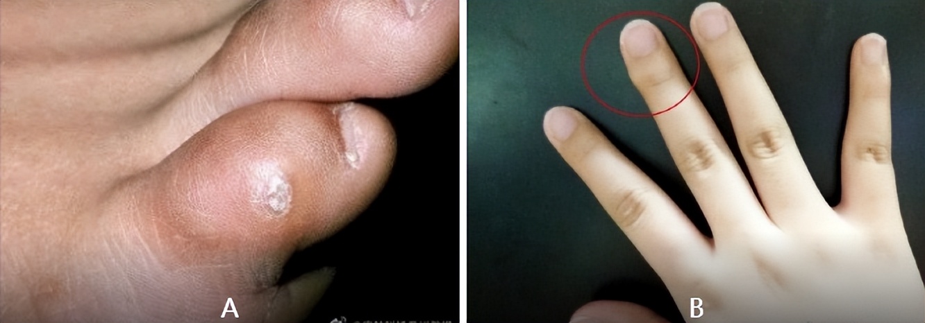 啥形状是鸡眼,什么形状是鸡眼