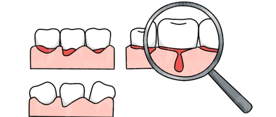 暨大穗华口腔种植一颗牙多少钱,暨大穗华口腔1980种牙靠谱吗