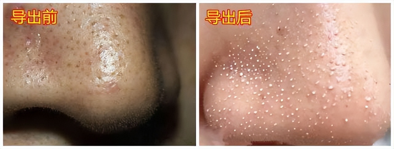 清洁面膜可以去黑头粉刺闭口吗,清洁面膜可以去除黑头吗