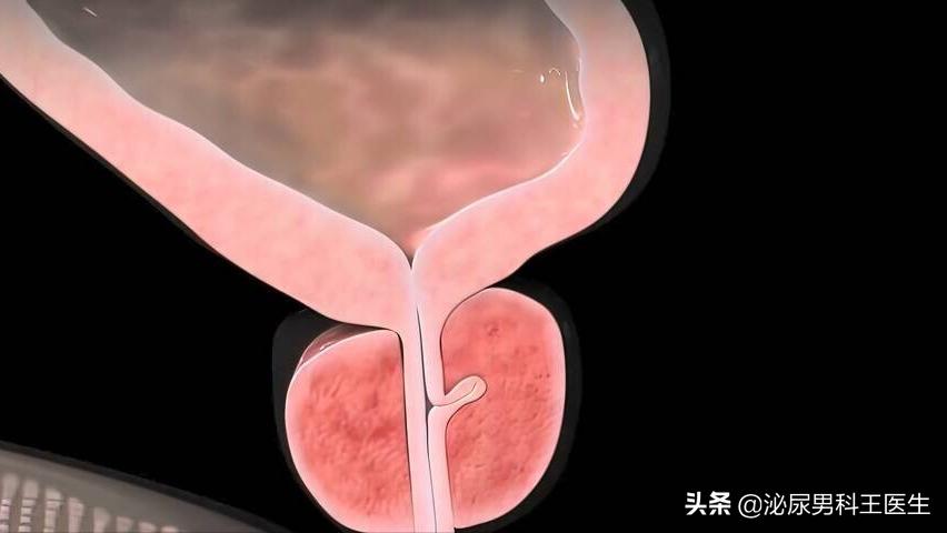 前列腺癌晚期骨转移症状有哪些,前列腺癌晚期患者临终前15个症状