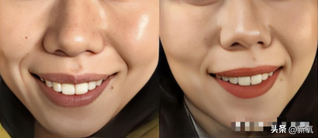 牙齿正畸和骨骼正畸的区别,牙齿正畸和眼轴增长有关系吗