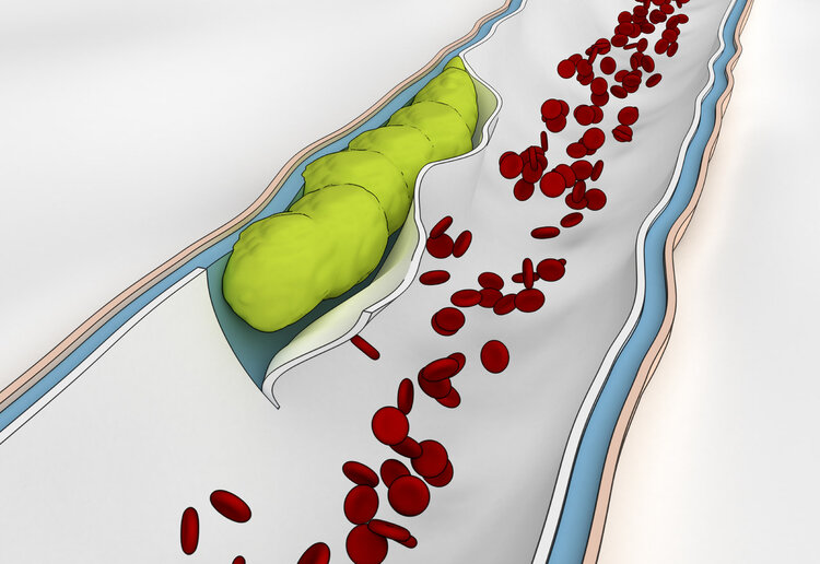当血栓来临时身体会出现什么症状,血栓的4个前兆占一项就得小心