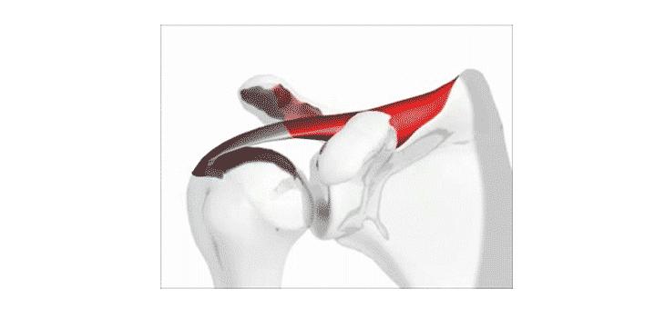 肩膀痛别再瞎折腾,肩痛别总让肩周炎背锅