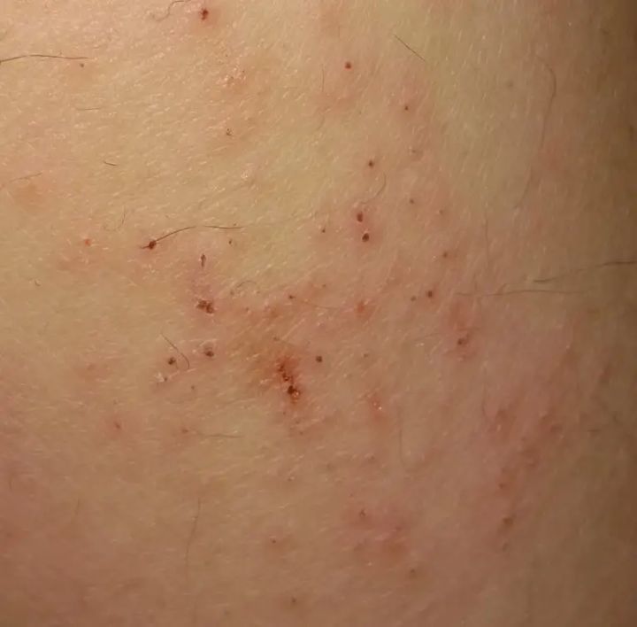 身上老是洗不干净是怎么回事,洗完澡皮肤干痒起白皮屑怎么回事