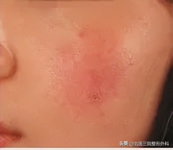 嘴角两侧面部有血丝,面部有血丝预示着什么