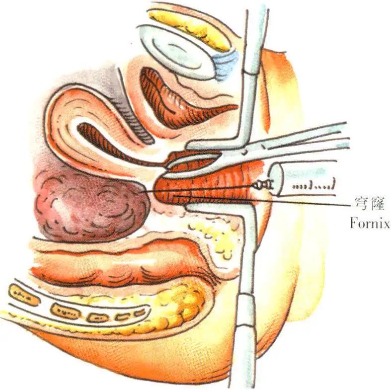 女人盆腔炎和盆腔积水应注意什么,盆腔炎宫颈炎检查前需要注意什么