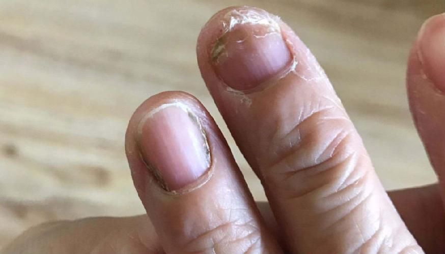 河南灰指甲连锁加盟哪家好,灰指甲加盟哪家靠谱全国诚招加盟