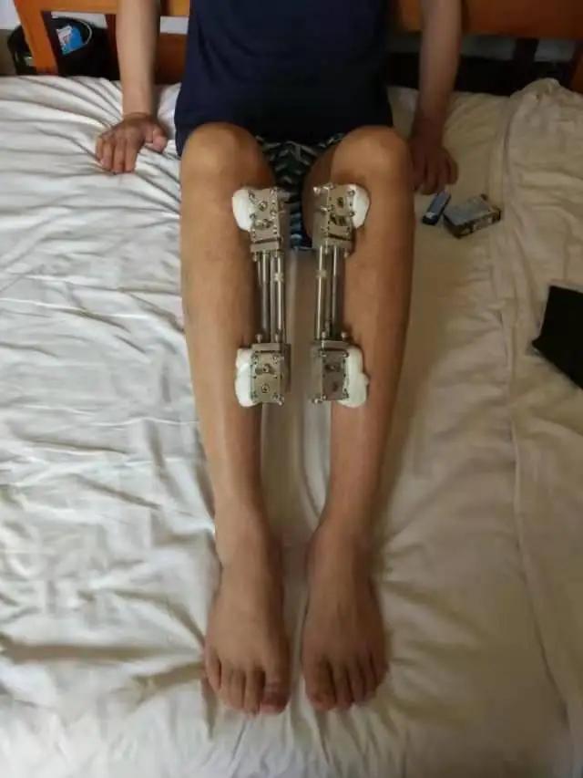 高中生花6.5万断骨增高,1米58男子花1500万增高