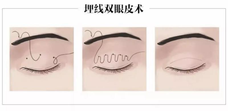 高考完想整容,高考结束去做双眼皮好吗