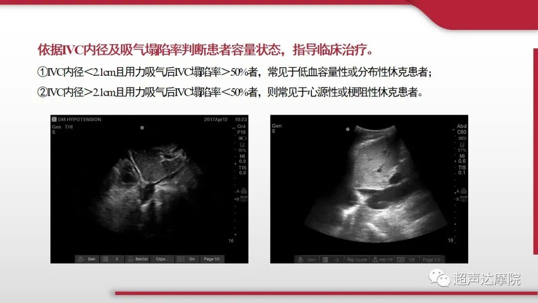 超声下腔静脉评估血容量,超声评估下腔静脉容量图片