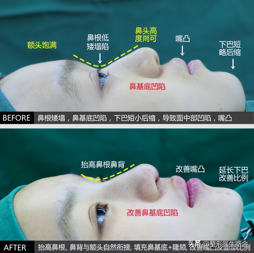 又高又自然的隆鼻,隆鼻是不是越自然越好看