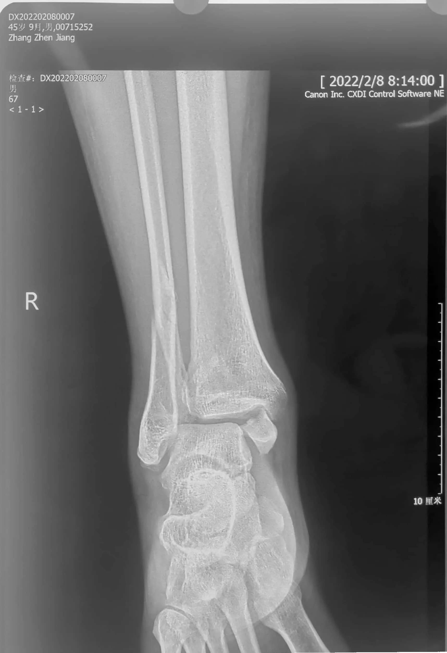 咋就不能先复一下位呢？手法复位就那么难吗？