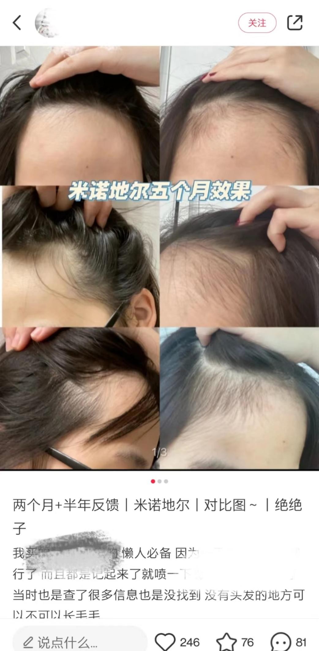 发际线对颜值的重要性,发际线对颜值的影响