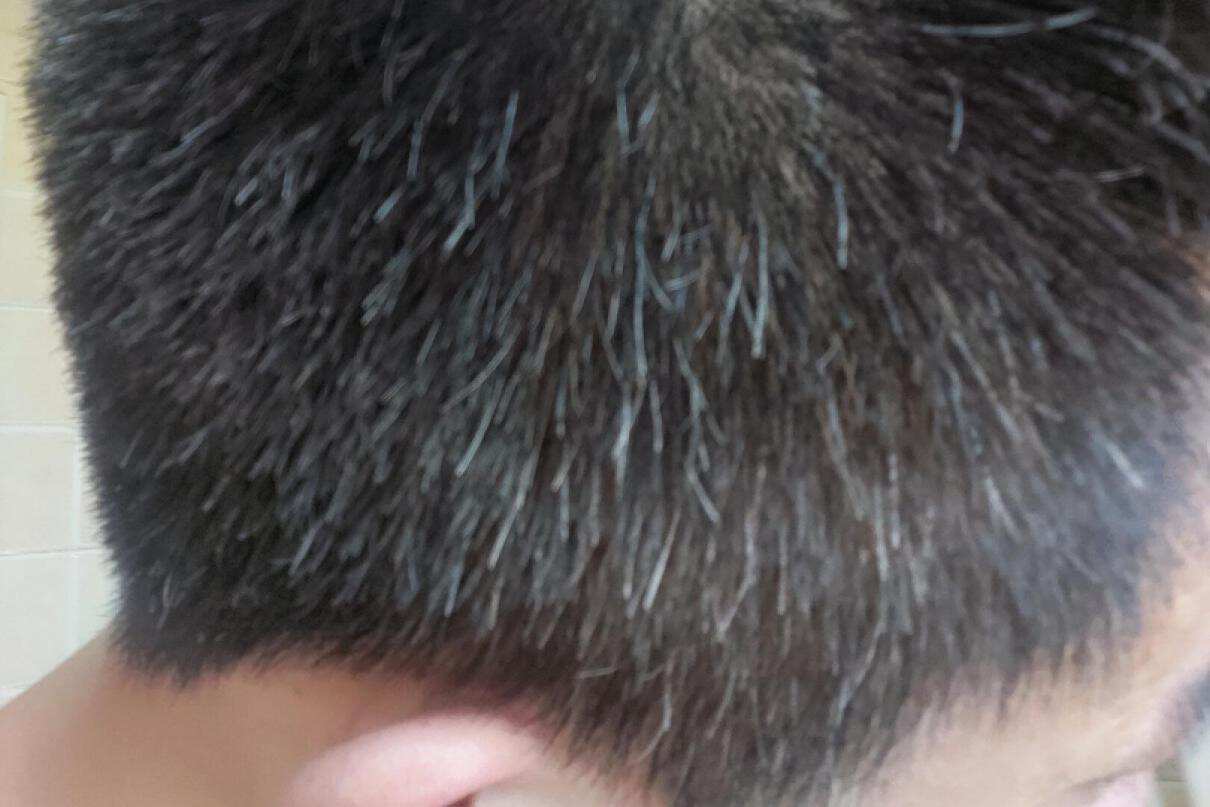 去头皮屑防掉发的洗发水推荐,脱发痒用哪一款洗发水比较好