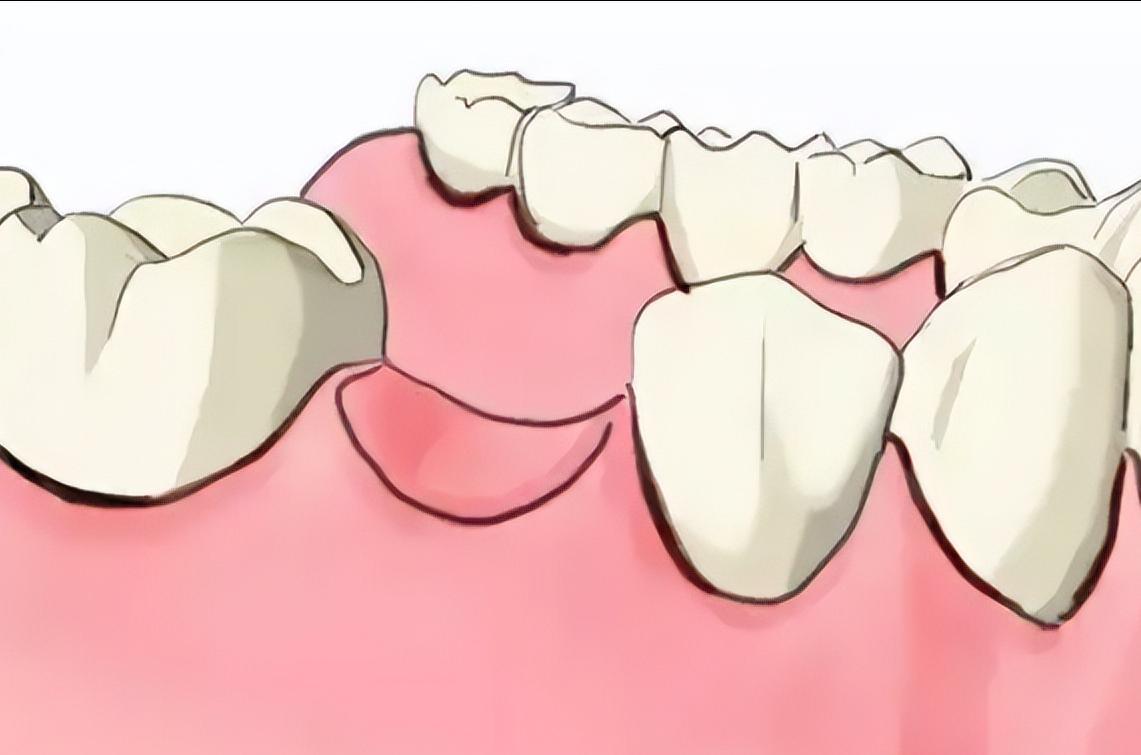 成人深覆合有必要矫正吗,深覆合矫正到一半后悔了
