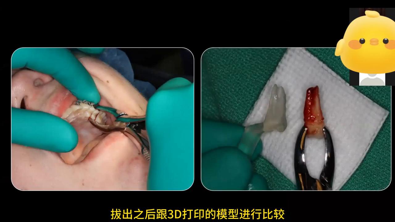 真实种牙视频全过程,种牙后悔的真实案例分析