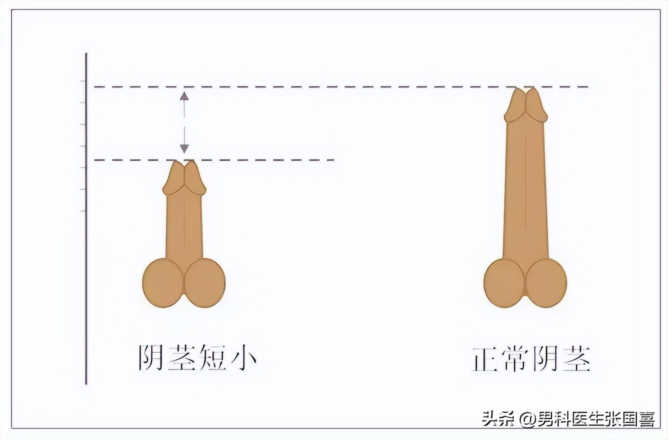 包皮长是不是一定要切掉,包皮过长一定要割掉吗23岁