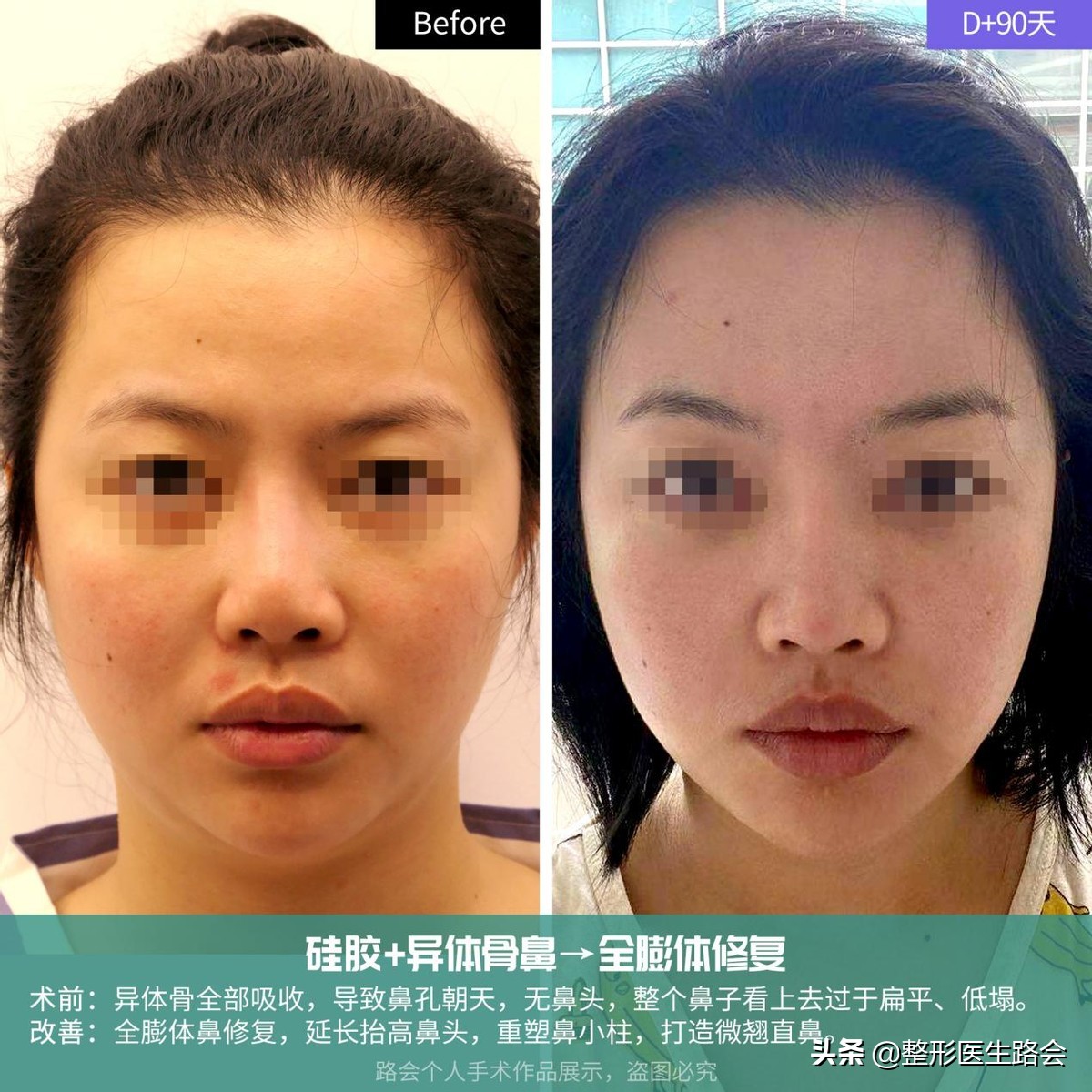 隆鼻失败鼻头有个坑的原因,隆鼻失败导致的鼻头凹陷怎么修复