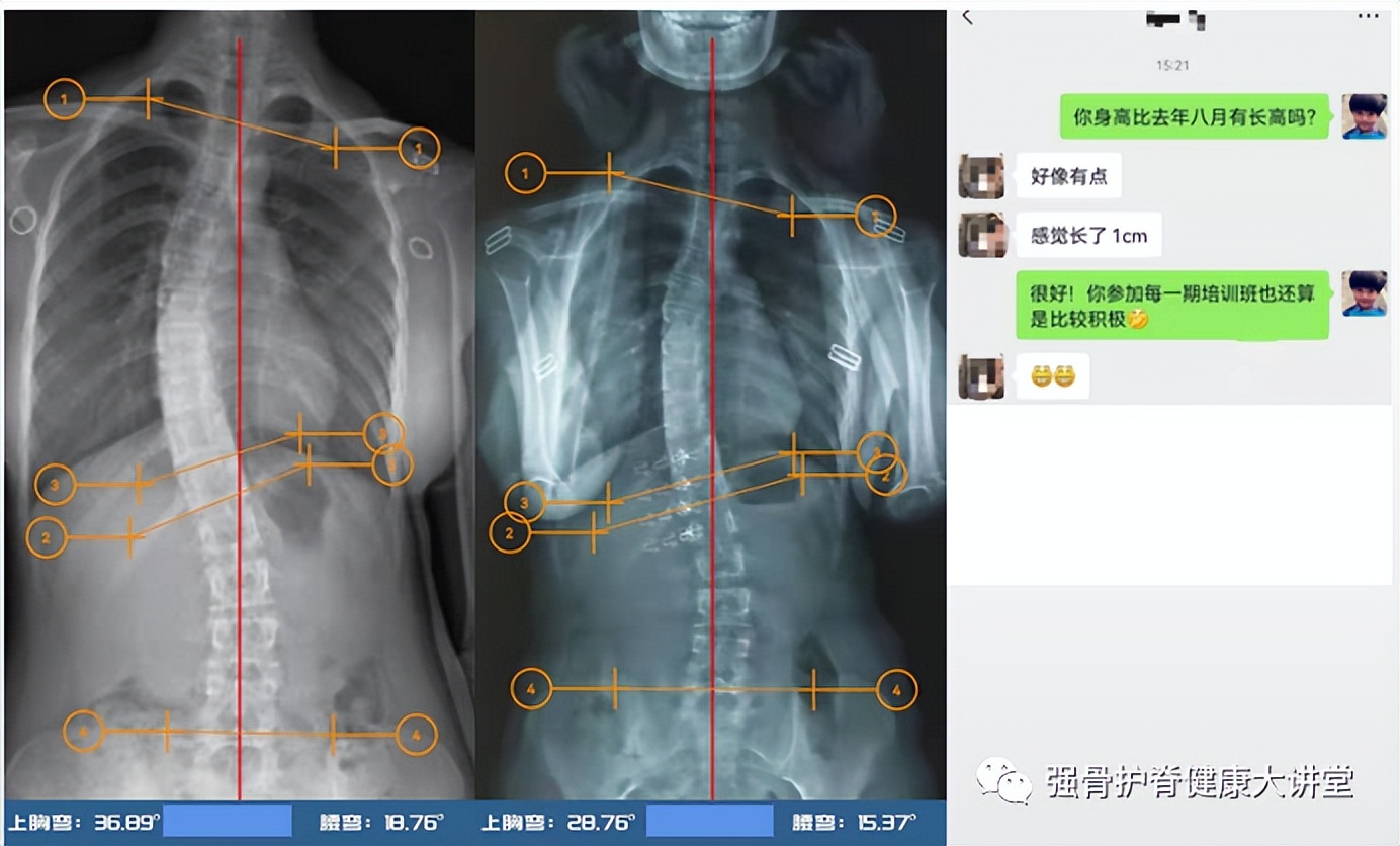 生长发育引起的脊柱侧弯,医学讲解脊柱侧弯怎样引起