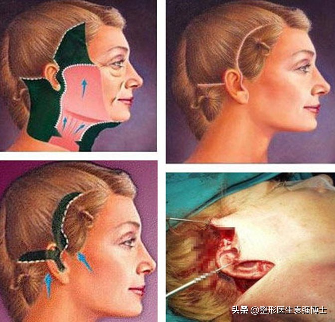 肚皮松弛拉皮手术有副作用吗,脸上做拉皮手术有无副作用