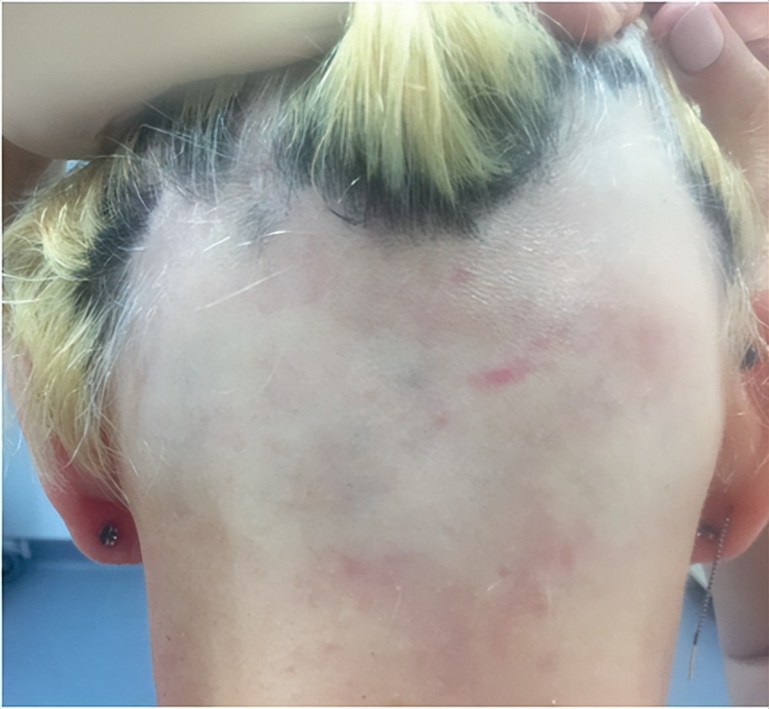 严重斑秃后长出白头发,斑秃用药后毛囊里长出细白发