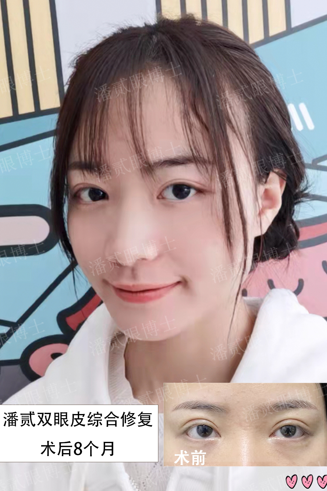 整容后眼睛不能闭合,整容失败眼睛无法闭合