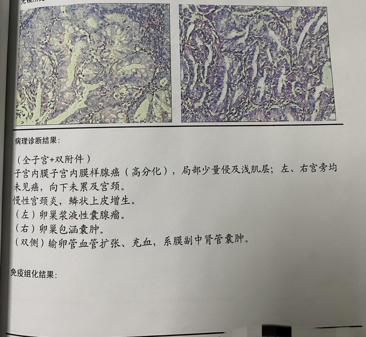 子宫内膜癌保留生育功能的治疗,我得了子宫内膜癌