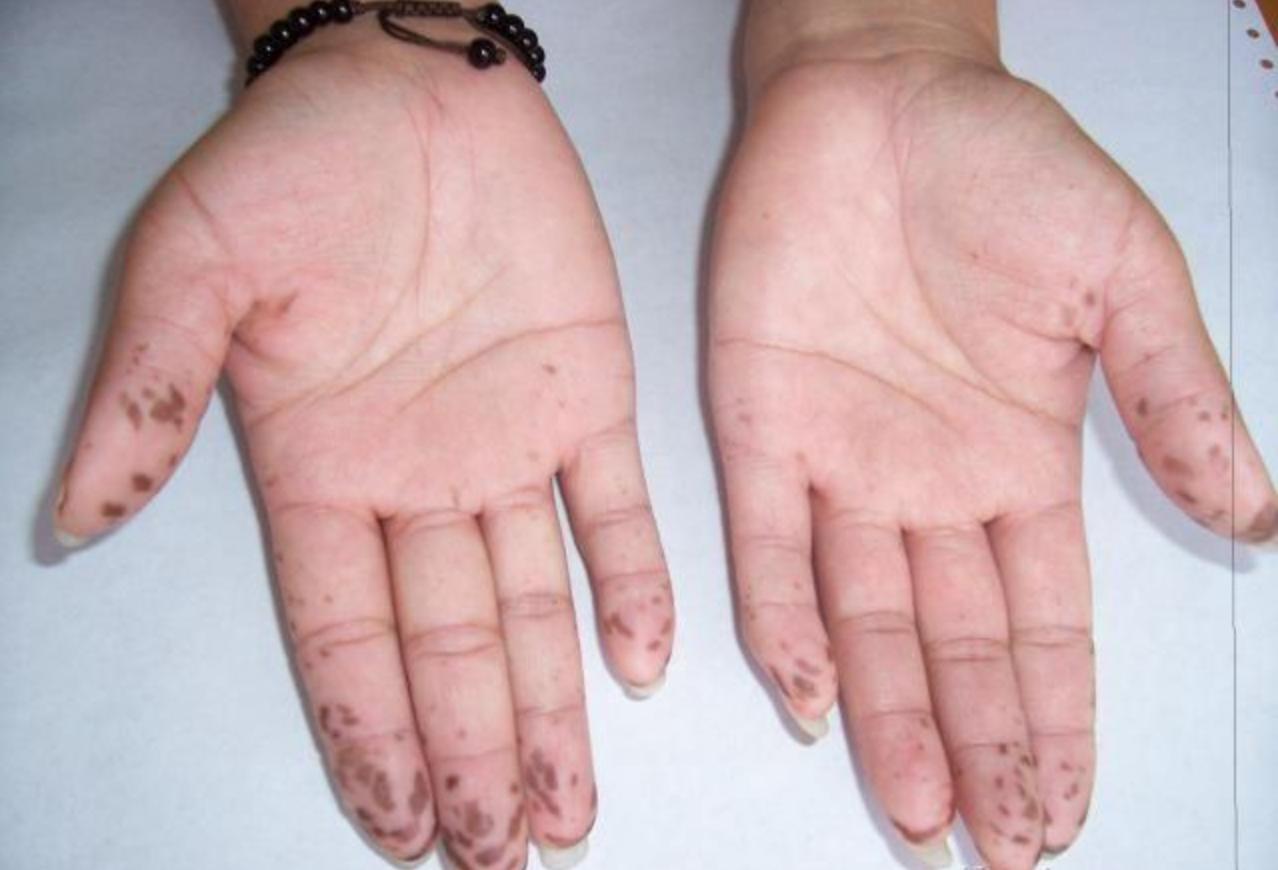 少年腹痛一年查出巨瘤,年轻小伙腹痛去医院