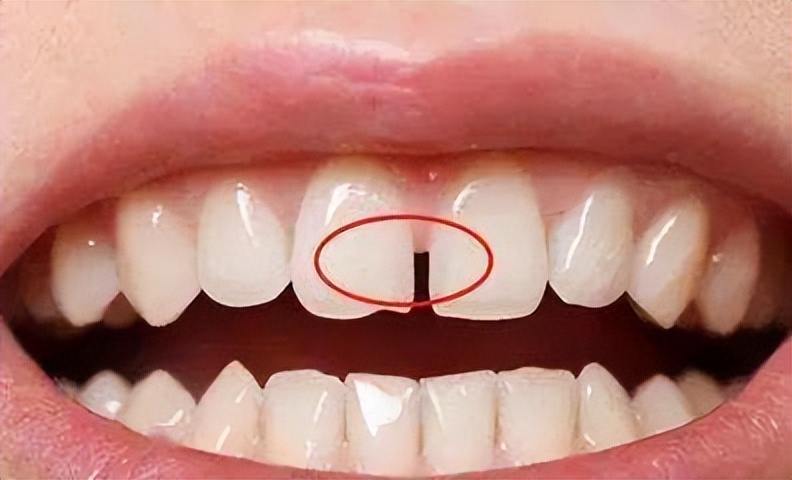 牙缝卡了东西导致牙缝变大怎么办,牙龈萎缩牙缝变大怎样缩小牙缝