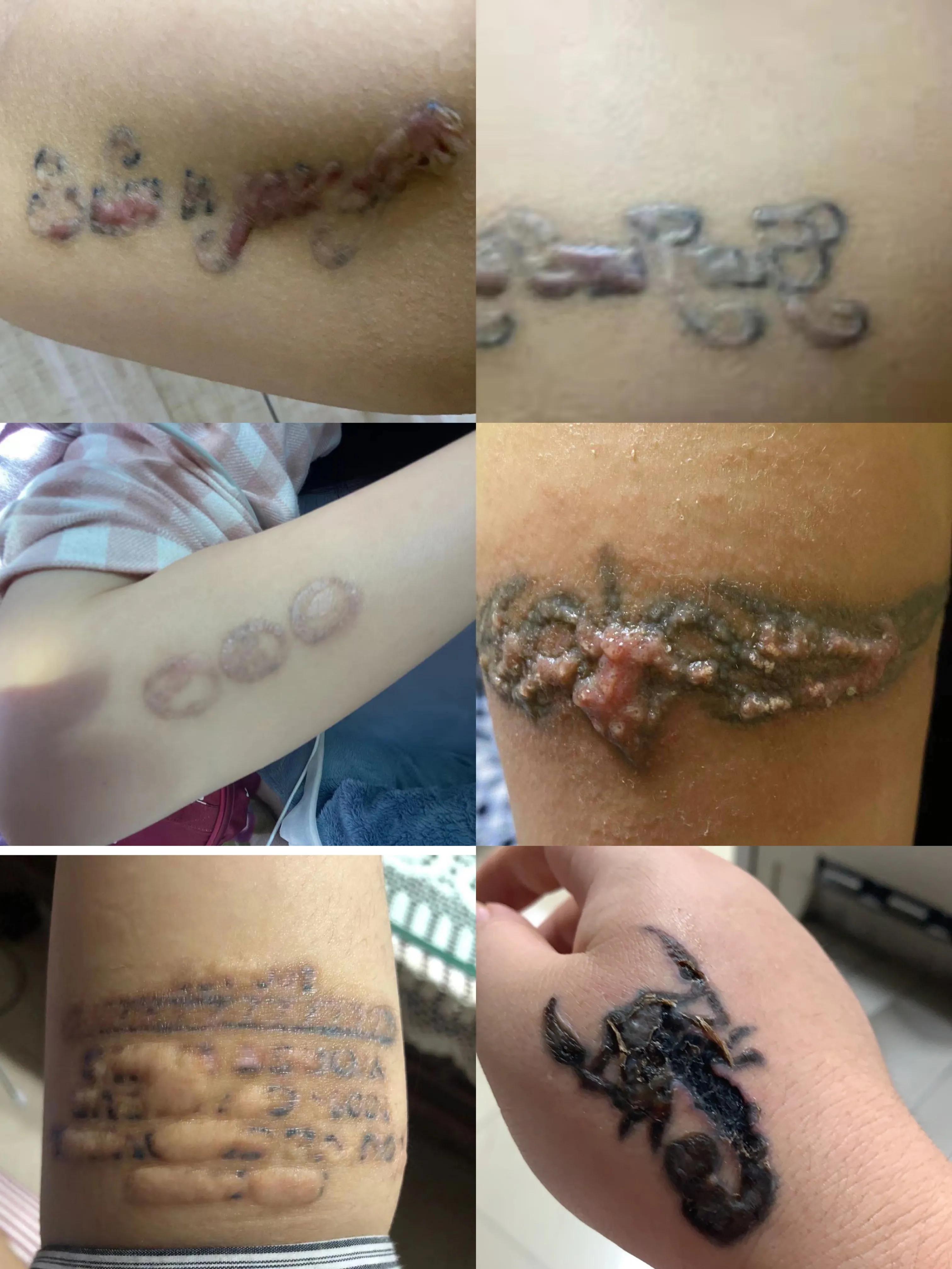 为洗纹身买单,洗纹身有什么代价