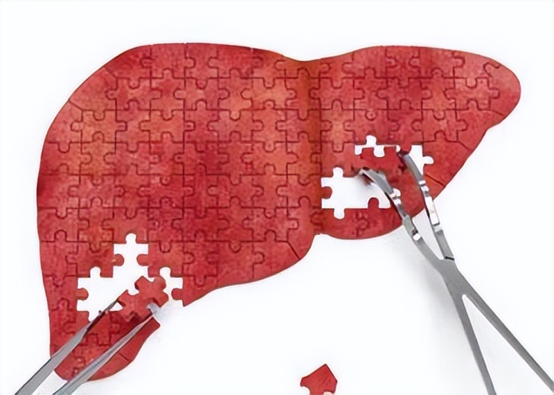 有肝掌是肝硬化几期,肝健康科普图文