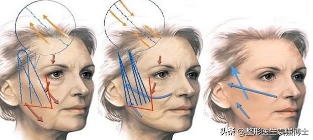 做完线雕不戴头套感觉撕拉痛,做完线雕为什么不能嚼硬东西