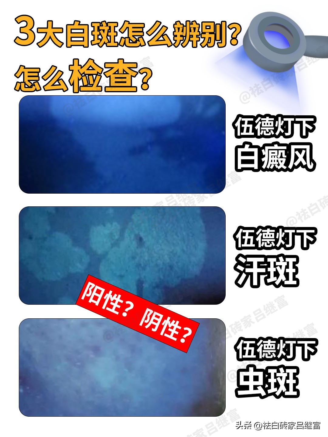 虫斑与花斑癣最主要区别,白癜风和汗斑最快鉴别方法