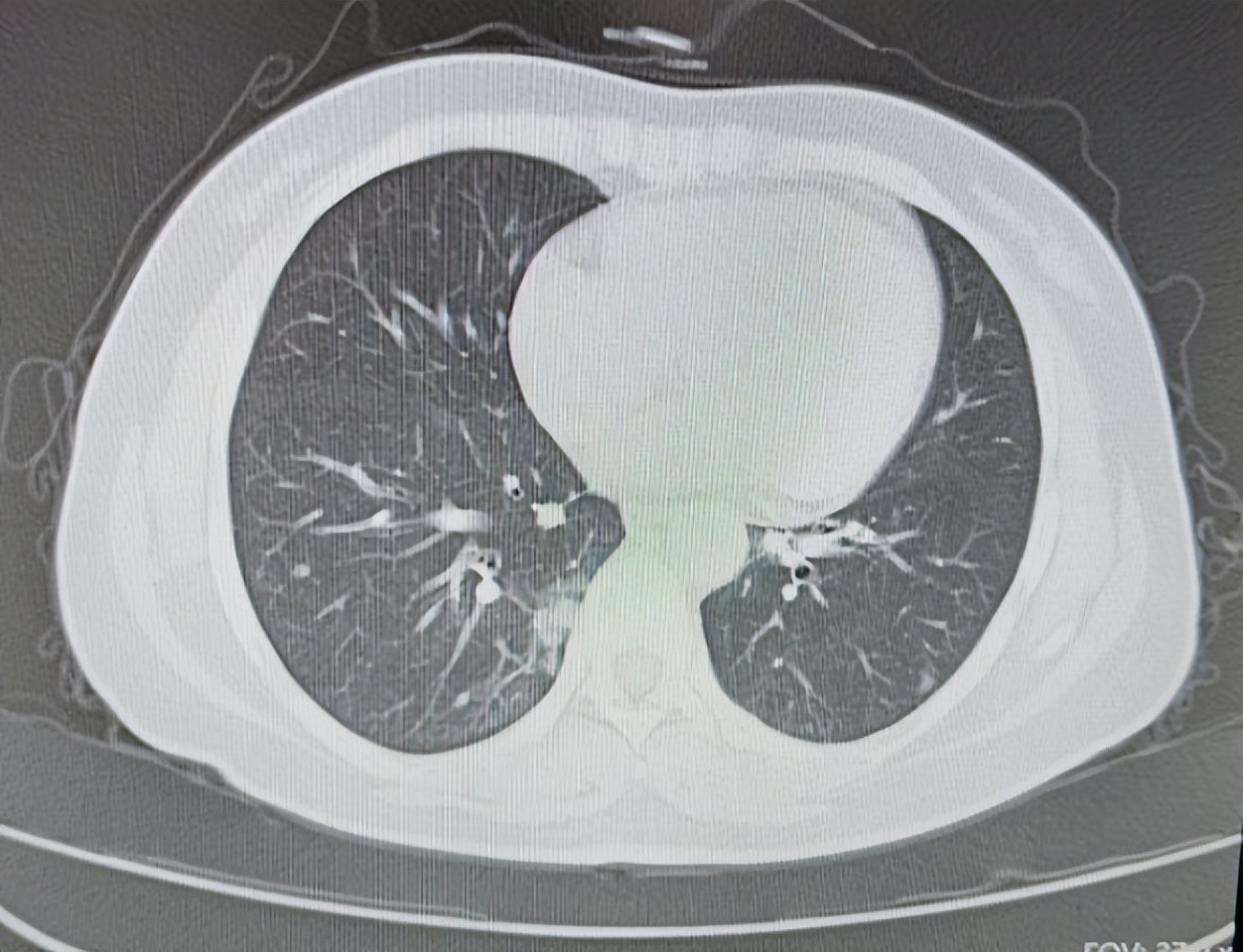 60岁大叔咳嗽不止疑似肺癌,李大爷治咳嗽方法