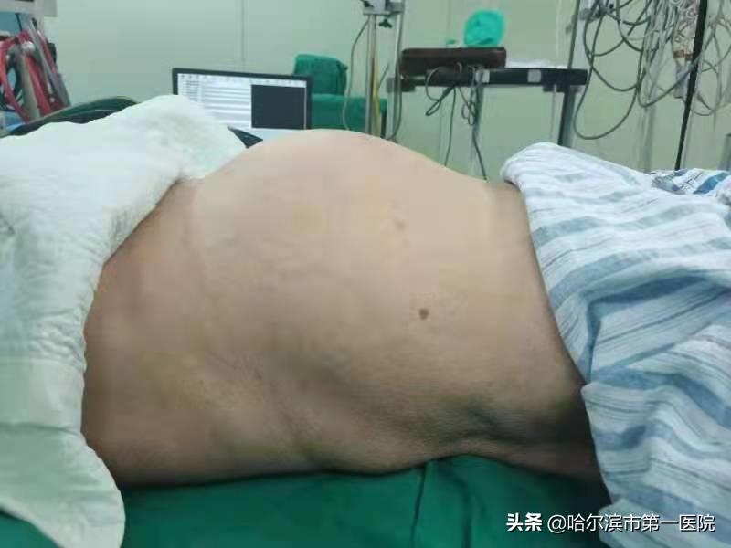 82岁老太肚子鼓包如足月孕妇原是“肿瘤”作怪—哈尔滨市第一医院妇二科利用“单孔腹腔镜”切除巨大卵巢肿瘤