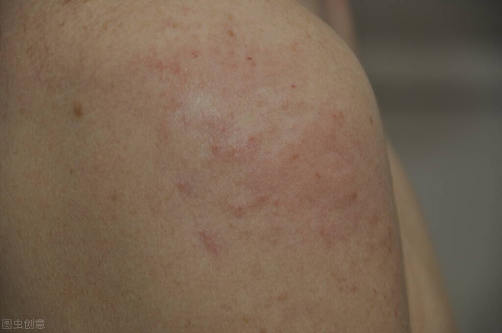 哺乳期妇女怎么预防宝宝湿疹,婴幼儿脸上湿疹可以如何预防