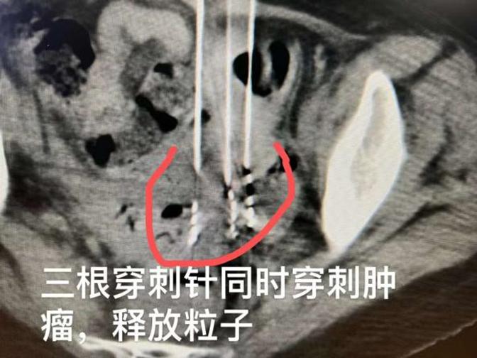 宫颈癌淋巴结转移中医治疗,宫颈癌盆腔淋巴结转移治疗方案