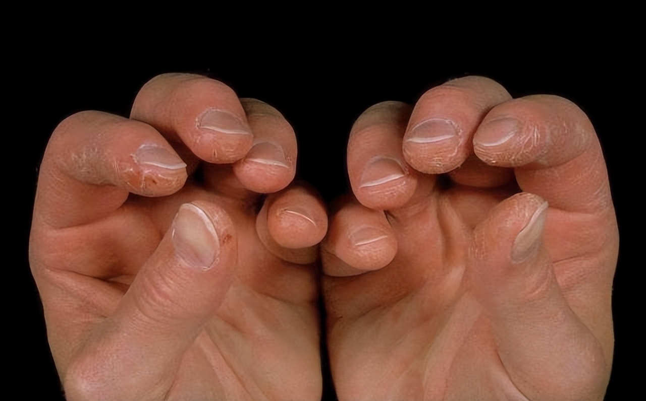 风湿免疫类疾病最怕什么,风湿免疫疾病如何预防