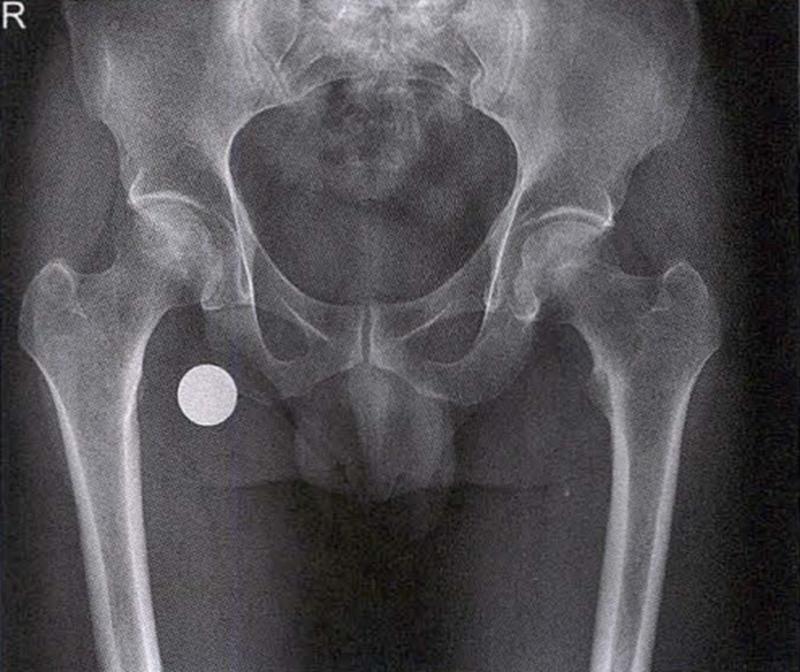 全国十大股骨头坏死诊疗中心,股骨头坏死诊疗方法有哪些