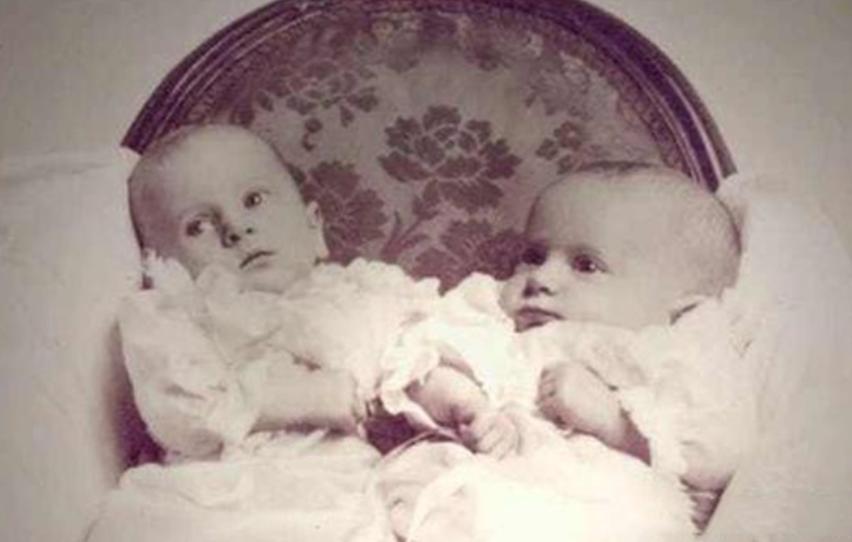 英国连体双胞胎姐妹,英国连体姐妹