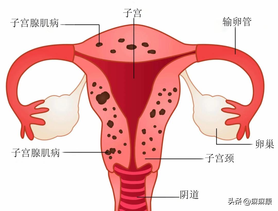 慢性盆腔炎的治疗方法,慢性盆腔疼痛哪治疗好