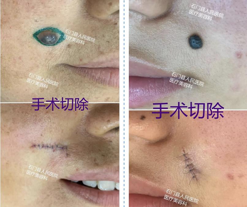 美丽无需“痣”疑！有痣别乱点，这些方法最靠谱