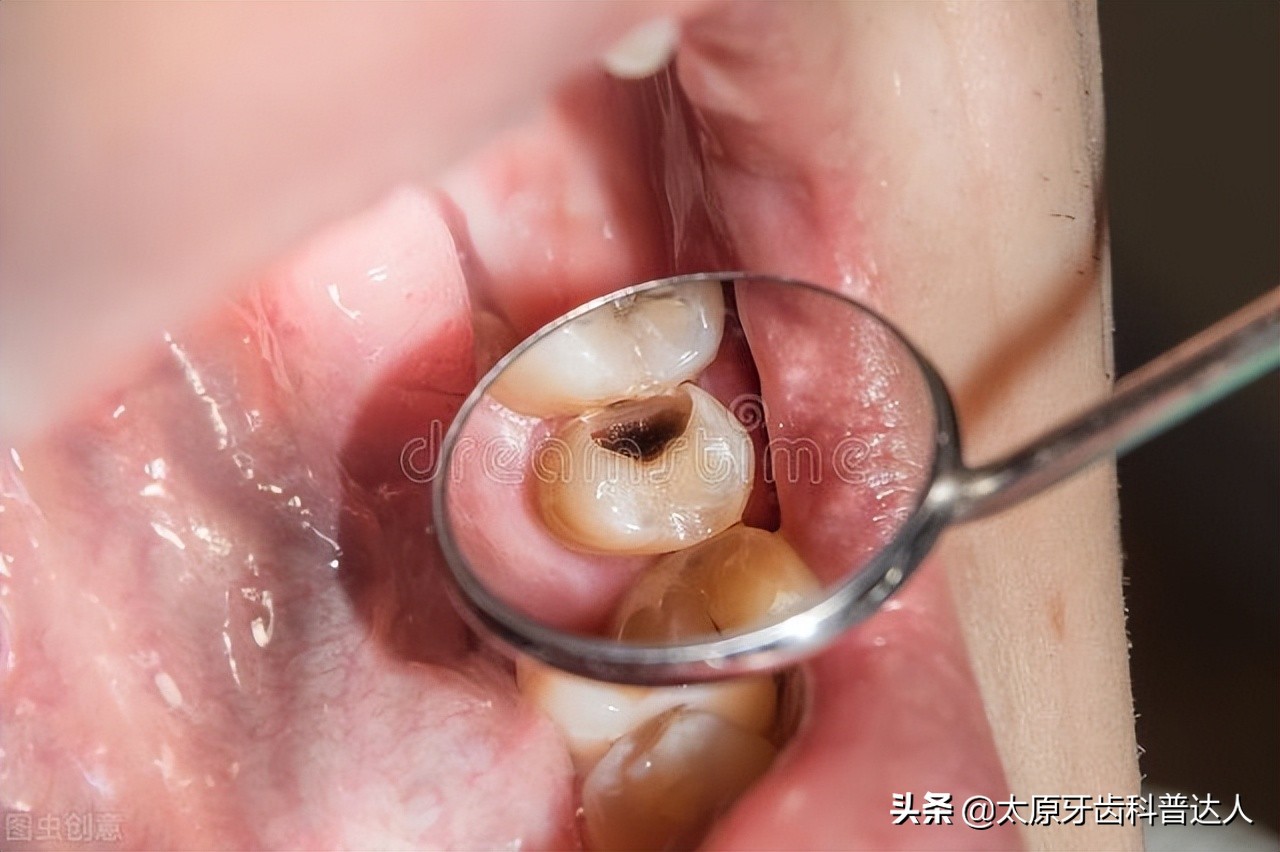 上火牙疼怎么办快速下火,上火牙疼吃什么最快降火