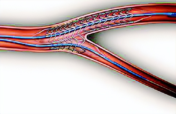 药物涂层球囊和支架哪种好,心梗用药物球囊好还是支架好