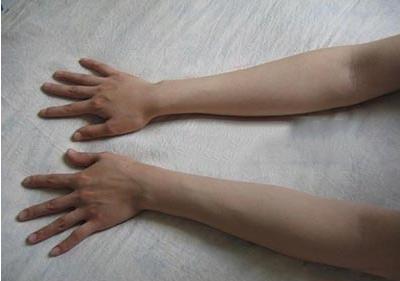 手腕无力手指笨拙虎口萎缩,手臂手掌无力萎缩的症状