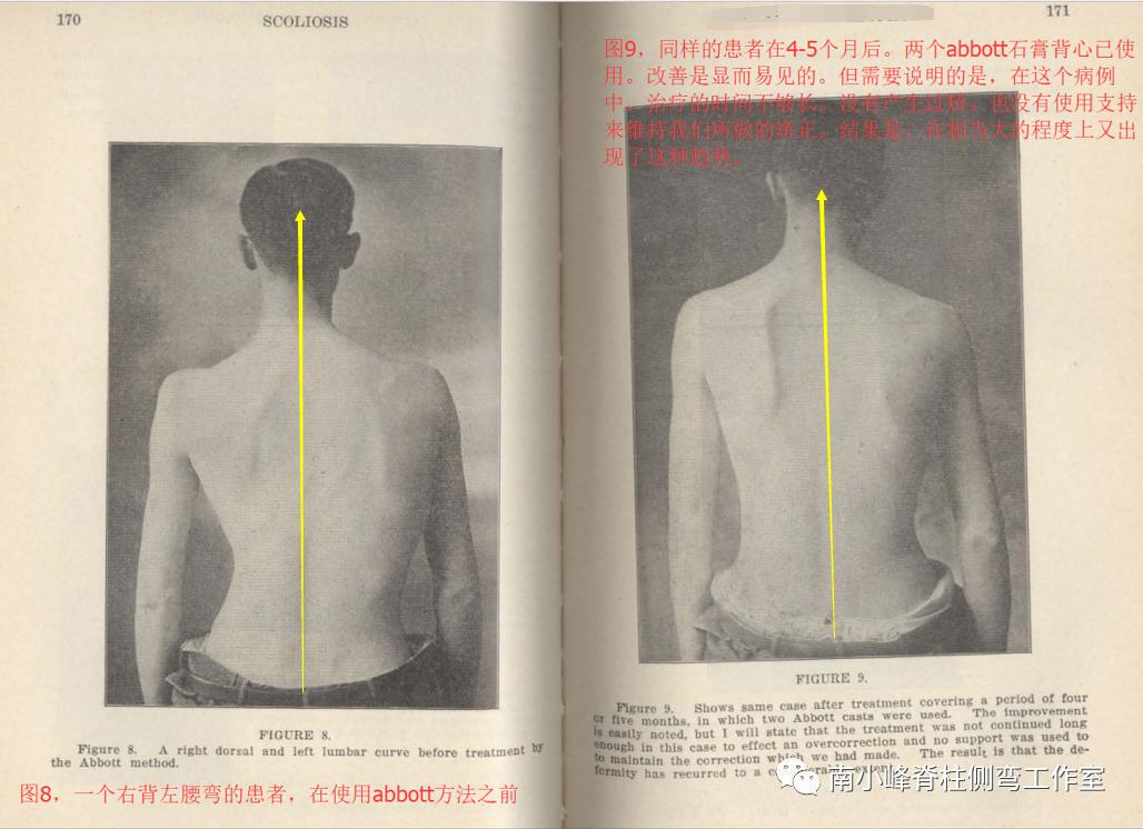 gbw硬质支具矫正脊柱侧弯,gbw支具案例