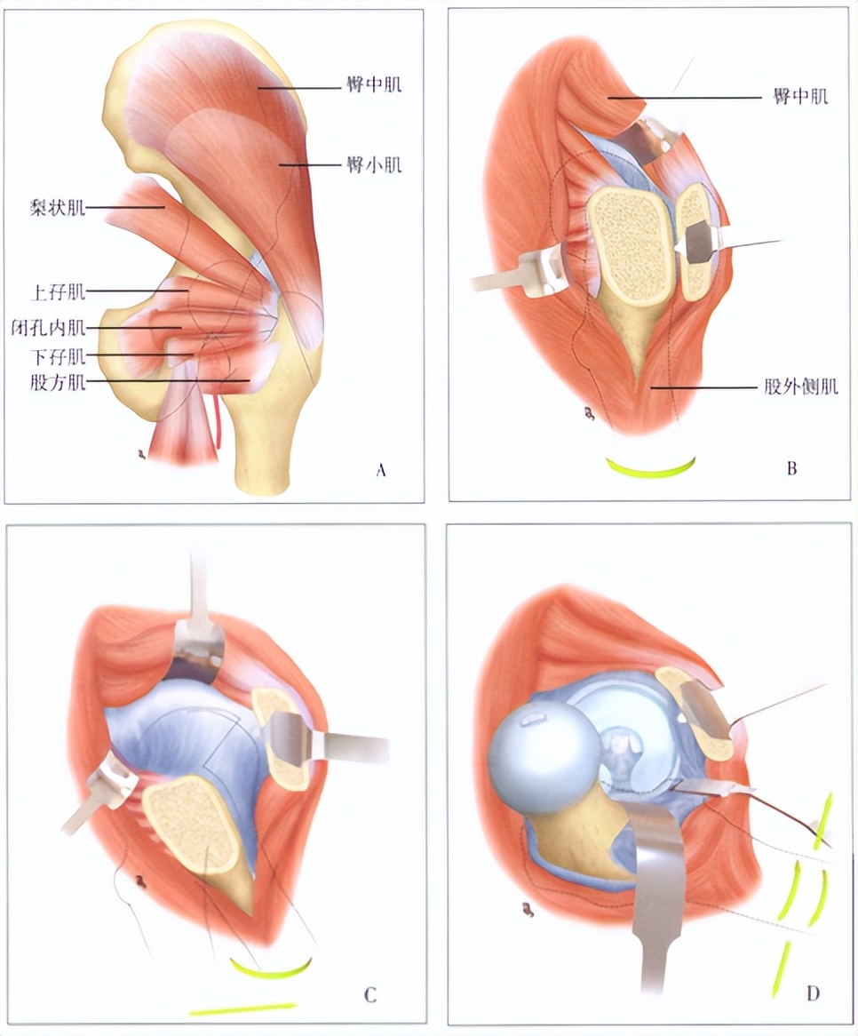 老人股骨头骨折手术,股骨头骨折最佳手术方法