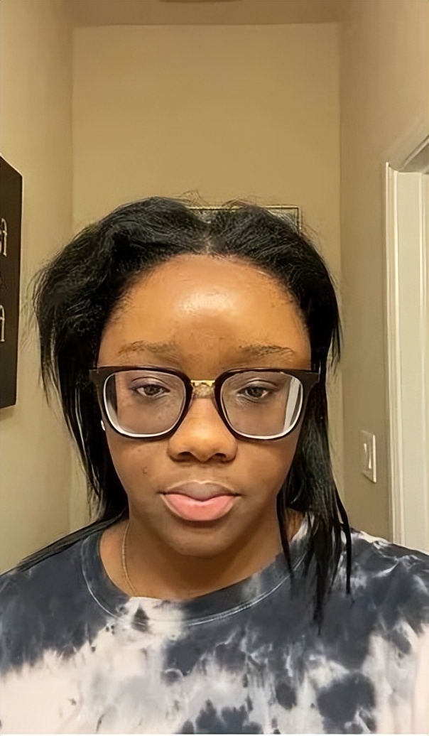 美国妹子染头发过敏全脸肿成emoji，不光失明还险些窒息